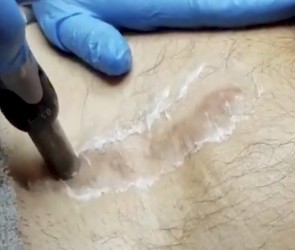 Litteken behandeling